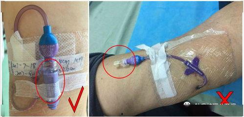 picc的维护视频,PICC导管维护操作步骤详解